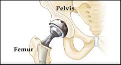 Image result for hip replacement